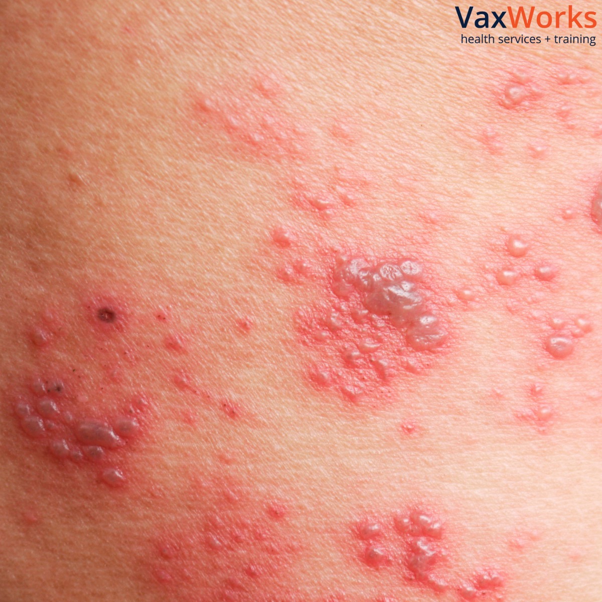 Chickenpox is an infection caused by the varicella zoster virus.